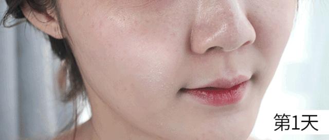 花了3万做激光,才彻底懂了:医生为什么劝你别去斑