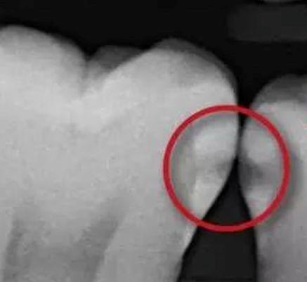 邻面龋可以变成静止龋吗,门牙邻面龋早期怎么处理