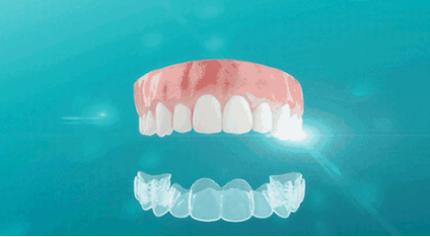 昆明龅牙矫正要多少钱,长沙轻微龅牙矫正要多少钱