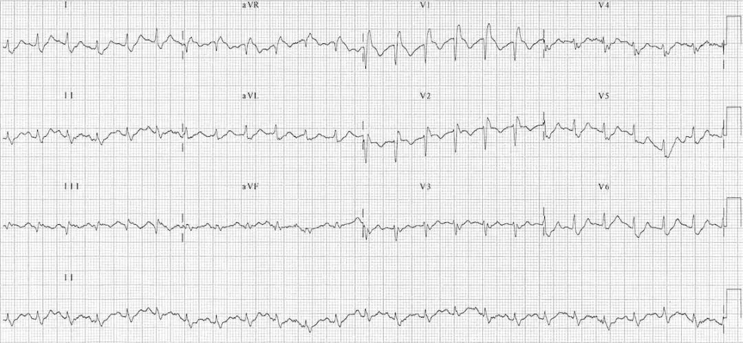 肺栓塞心电图表现是什么,肺栓塞的心电图改变