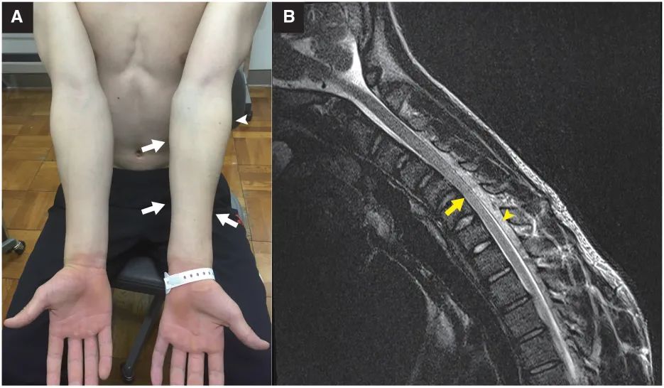 平山病：斜坡征和膜-壁分离