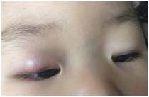 眼皮长了小疙瘩自己掐下来了,眼皮上长了个小肉粒是疣吗