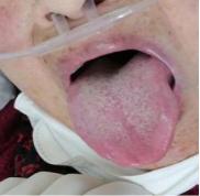 新冠肺炎冠状病毒,新型冠状病毒肺炎中医医案精选