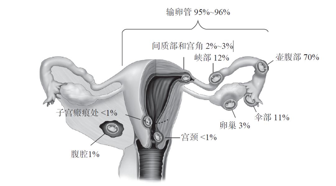 临床诊断先兆流产异位妊娠严重吗,持续性异位妊娠的临床症状