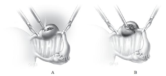 临床诊断先兆流产异位妊娠严重吗,持续性异位妊娠的临床症状