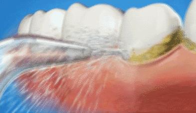 种植牙科普：揭秘种植牙修复全过程，每个步骤都很重要