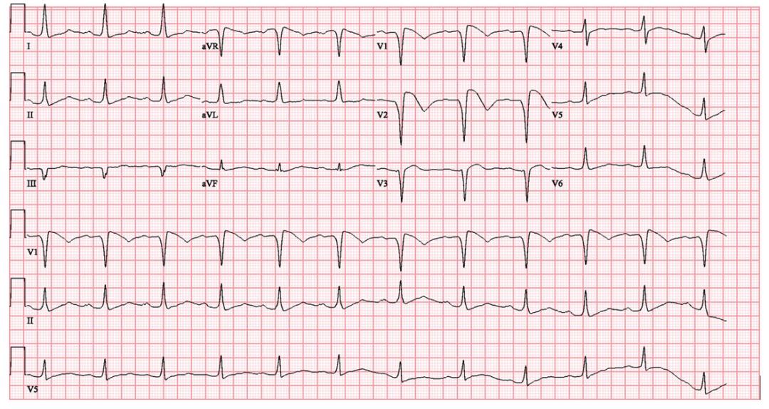 三兄弟接连变痴呆去世,三兄弟遭害后续