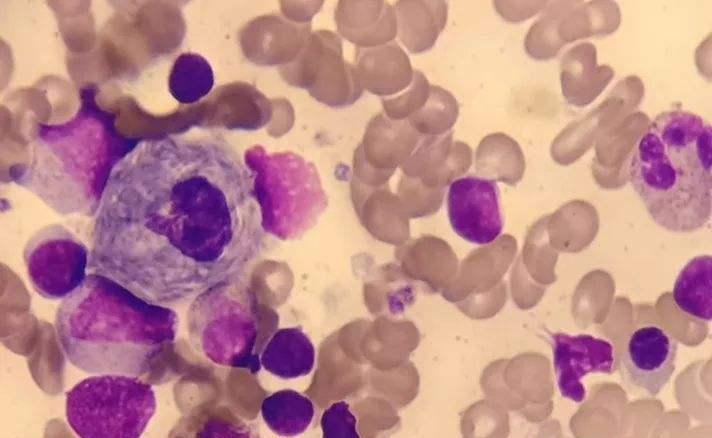 三次妊娠，三次胎儿水肿引产，终得梦圆！