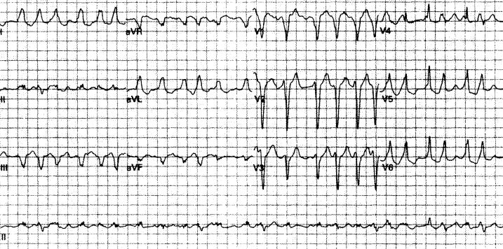 室速全名叫什么,室速的解读和识别