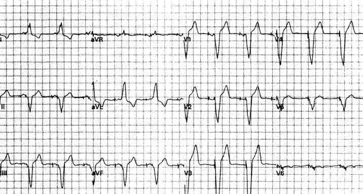 室速全名叫什么,室速的解读和识别