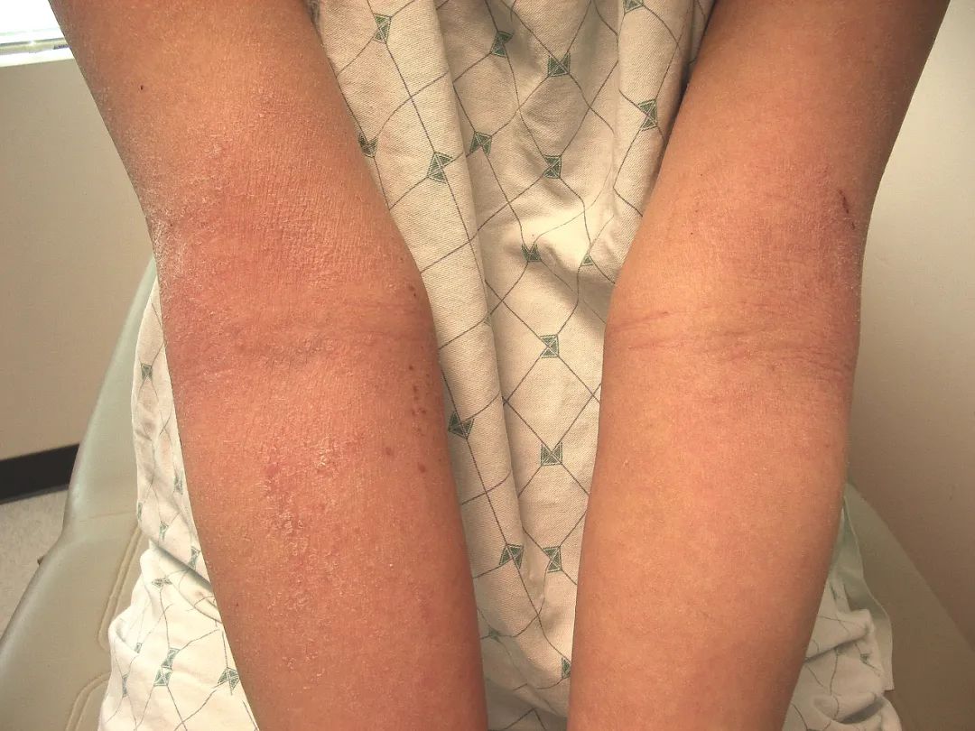 儿童特应性皮炎,儿童特应性皮炎倪海厦