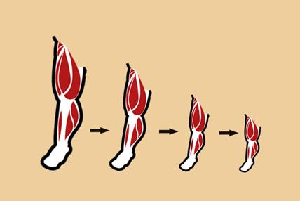 大腿肌肉严重萎缩,肌肉细胞萎缩