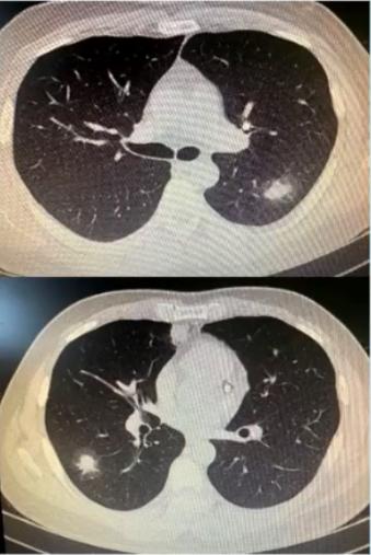 支原体肺炎症状中医诊治,成人肺炎支原体肺炎诊治专家共识