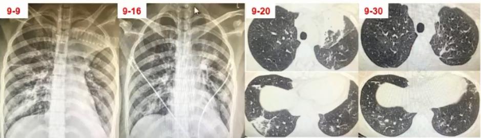支原体肺炎症状应该注意什么,支原体肺炎这些症状要警惕
