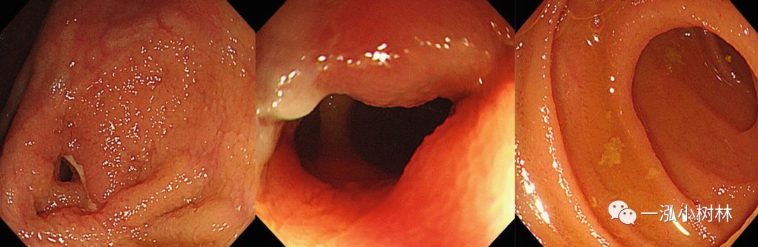 炎症性肠病内镜下表现,炎症性肠病早期筛查结果