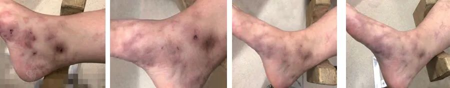 小腿处出现局部皮肤溃疡的症状,小腿下肢溃疡治疗要多久