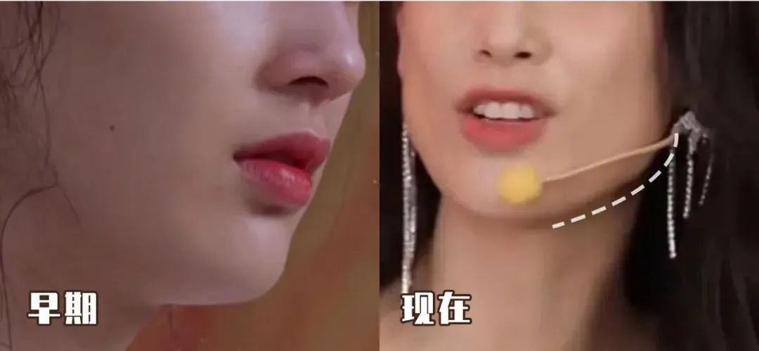 脸越来越圆胖是怎么回事,为什么腮和脸突然胖了好多