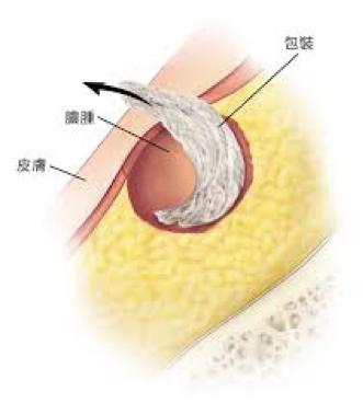 炎症的自述：发生、机理和结局