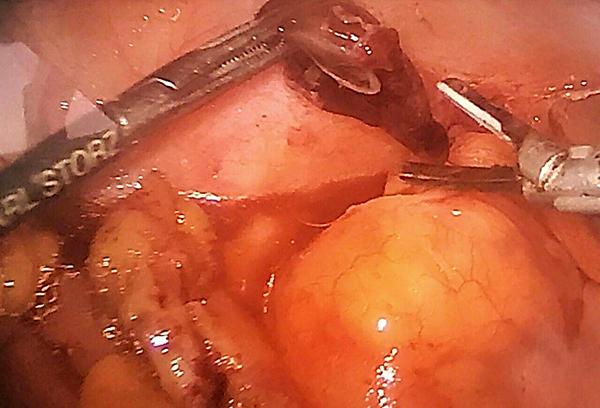 小儿急性腹痛常见原因,急性腹痛伴休克最常见的原因