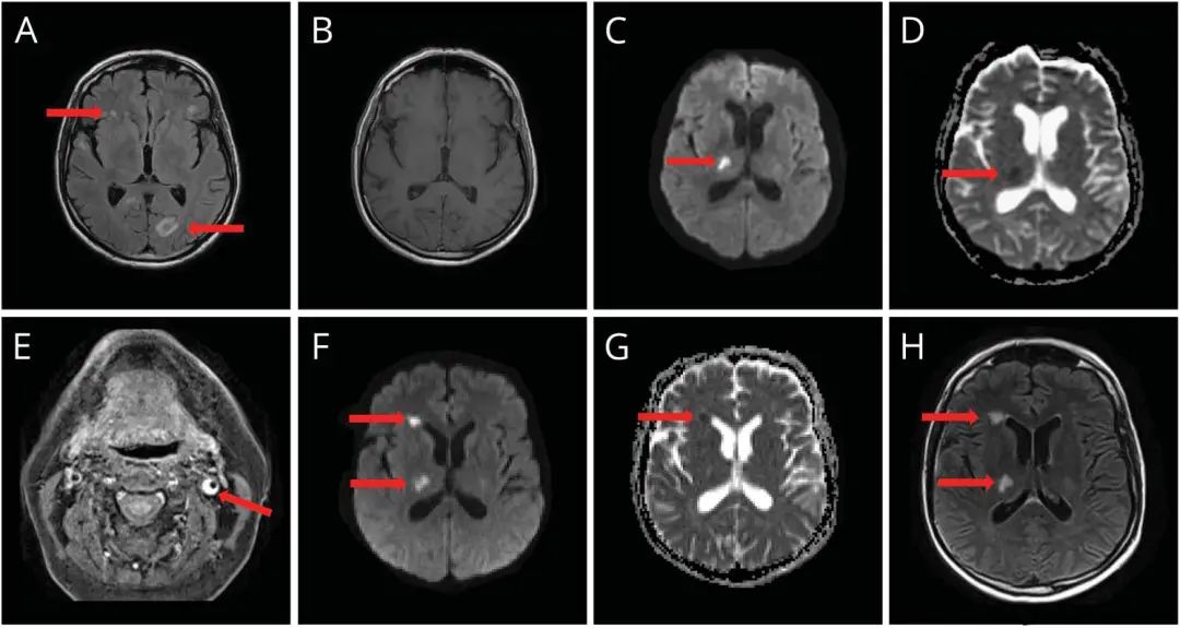 水痘带状疱疹病毒引起颅内感染,水痘带状疱疹病毒侵入到脑子
