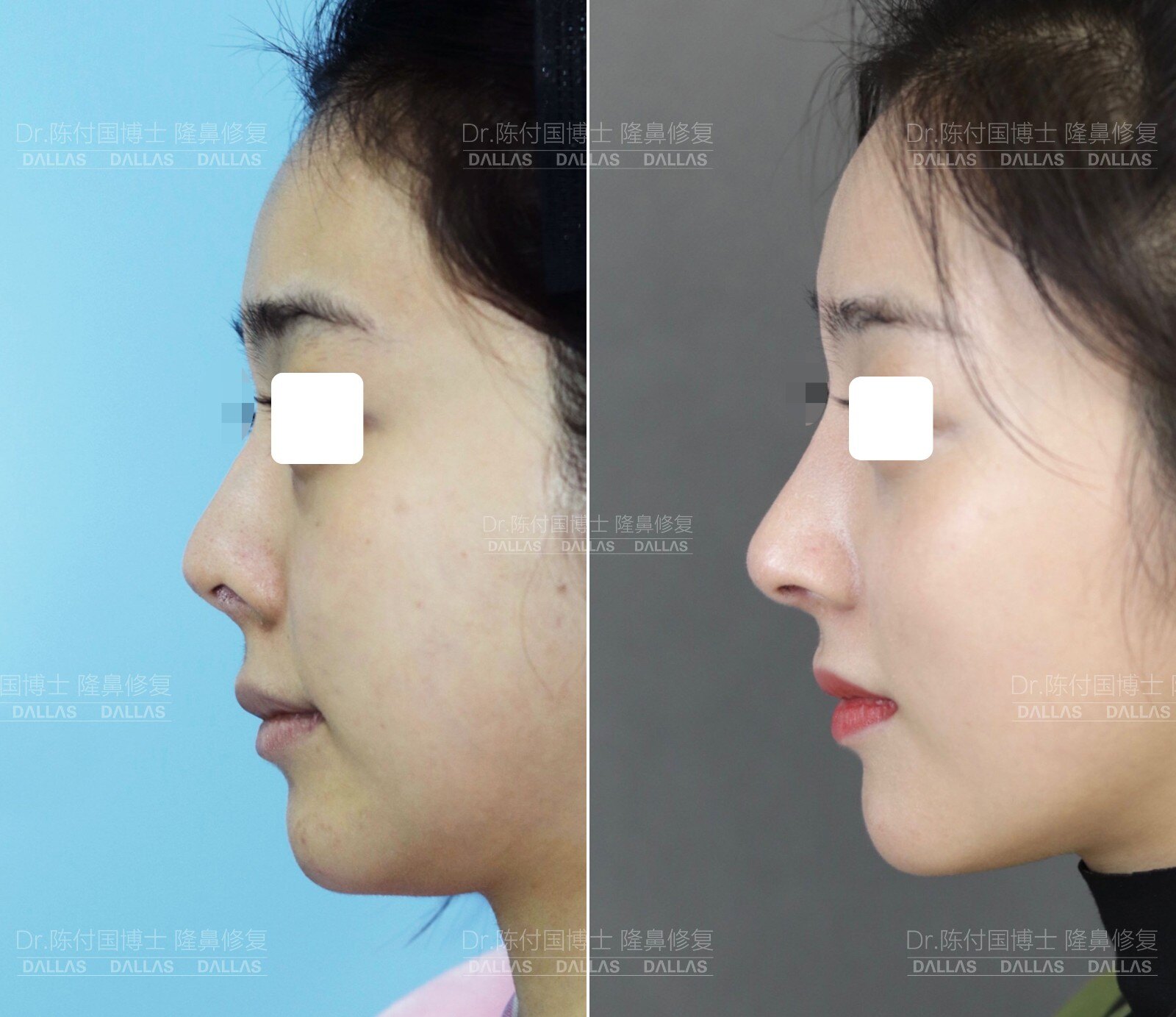 隆鼻鼻尖显形露鼻孔怎么修复,隆鼻修复微驼峰