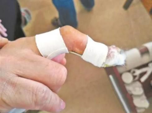 打球指头弯了怎么办,中国高中生打球指头弯了