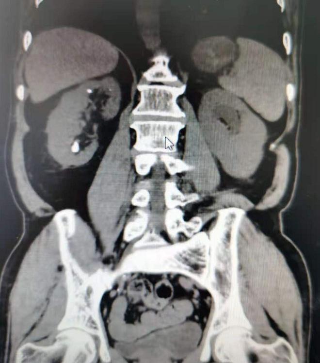 兰大二院泌尿外科住院部,经皮肾镜碎石取石术最新研究进展