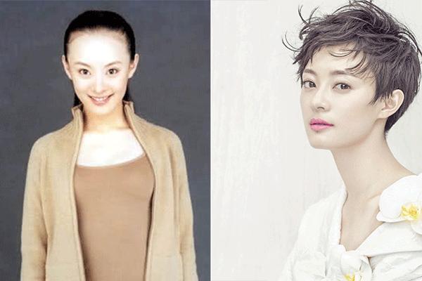 发际线高怎么办用什么药,发际线高怎么办改善