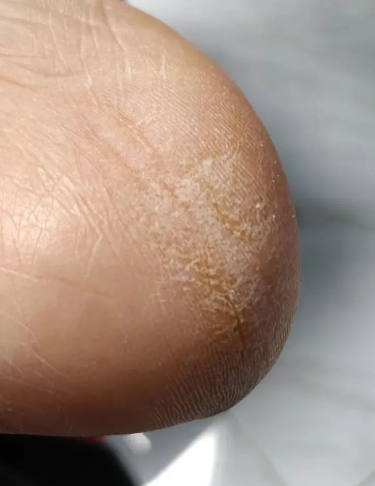 脚上真菌感染脱皮干裂怎么办,脚上脱皮又痒是真菌感染