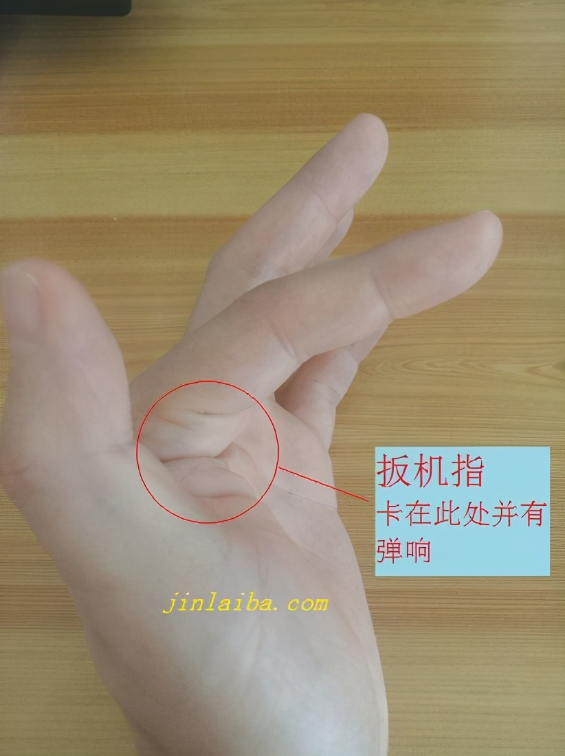 扳机指康复操,扳机指如何治疗