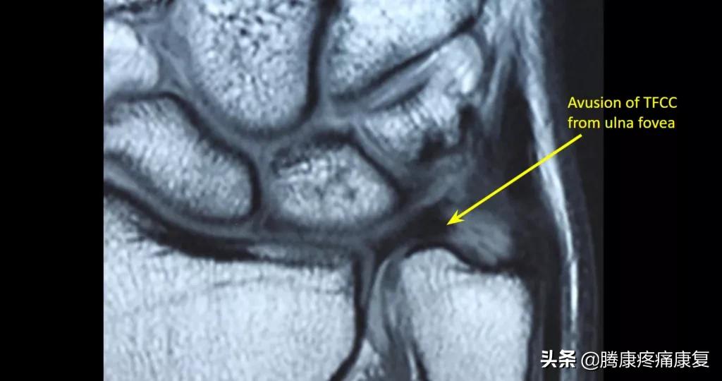 腕关节三角纤维软骨复合体损伤,三角纤维软骨损伤最佳治疗方法