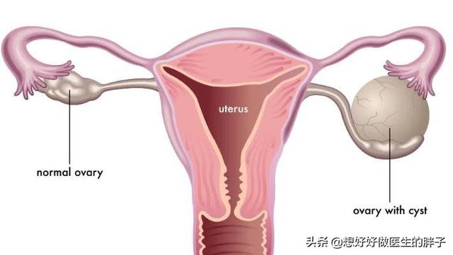 辟谣囊肿手术,如果囊肿是良性的话要不要做手术