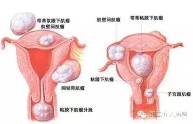 子宫肌瘤手术几天能出院,子宫肌瘤一定要手术么