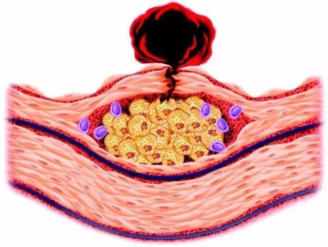 怀孕血压高吃什么水果,怀孕血压高可以顺产吗