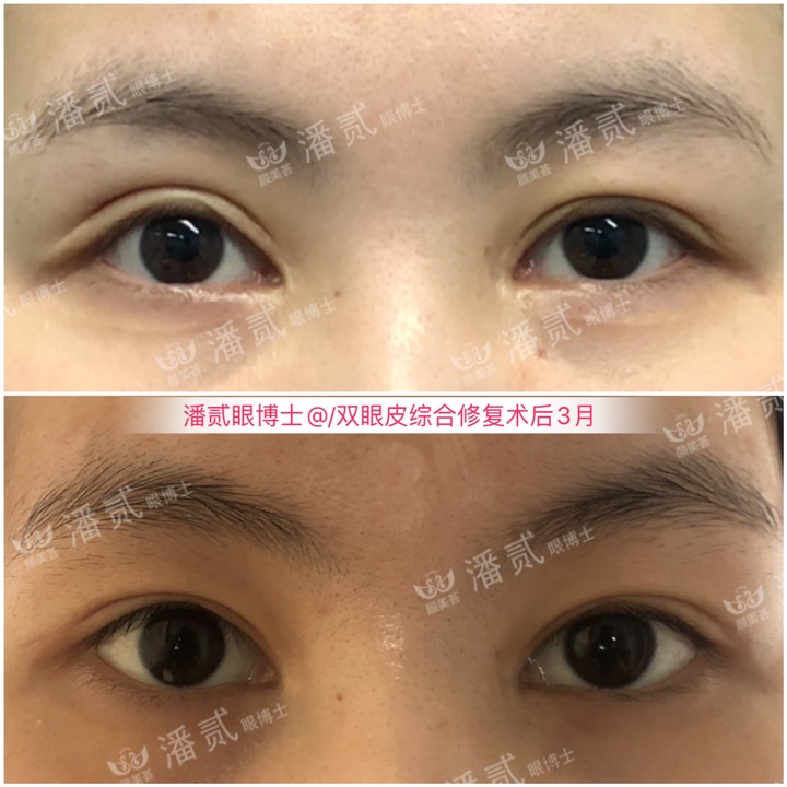割双眼皮眼皮压下来会恢复吗,割双眼皮以后会松弛更快吗