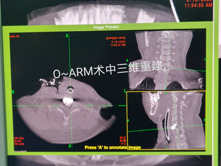 疫情期间颈椎病发作怎么办,疫情间躺久了头昏眼胀怎么治