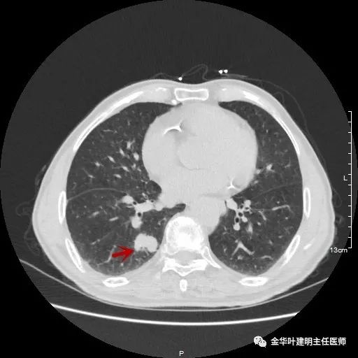 多发原发肺癌能根治吗,肺部原发性恶性肿瘤好治