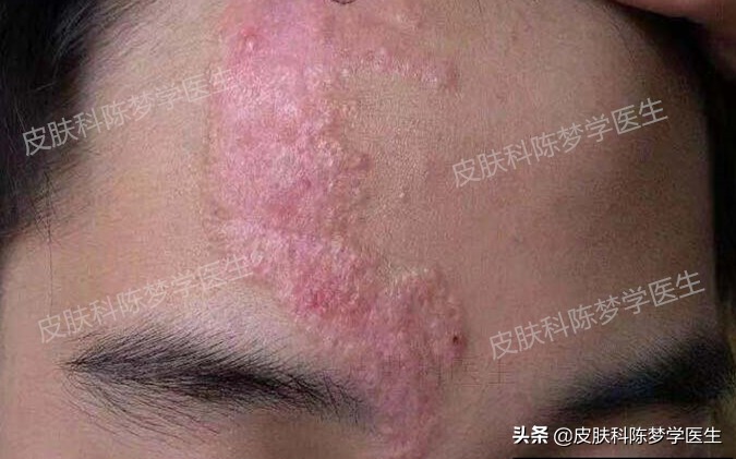 色斑和褐斑,根治面部黑褐斑的方法