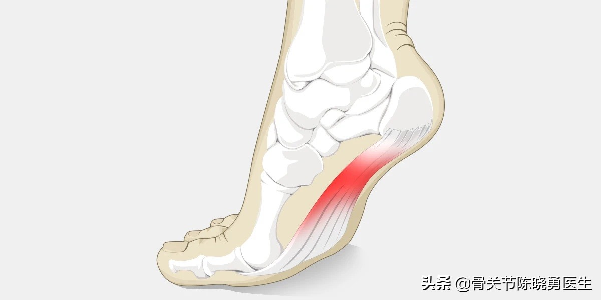足弓处肿胀疼痛怎么办,内侧足弓疼痛是什么原因