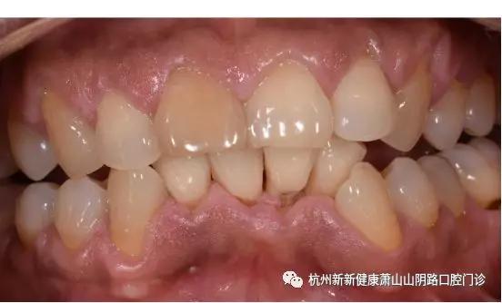 有了坏牙可以通过刷牙治疗吗,烂牙什么时候刷牙好