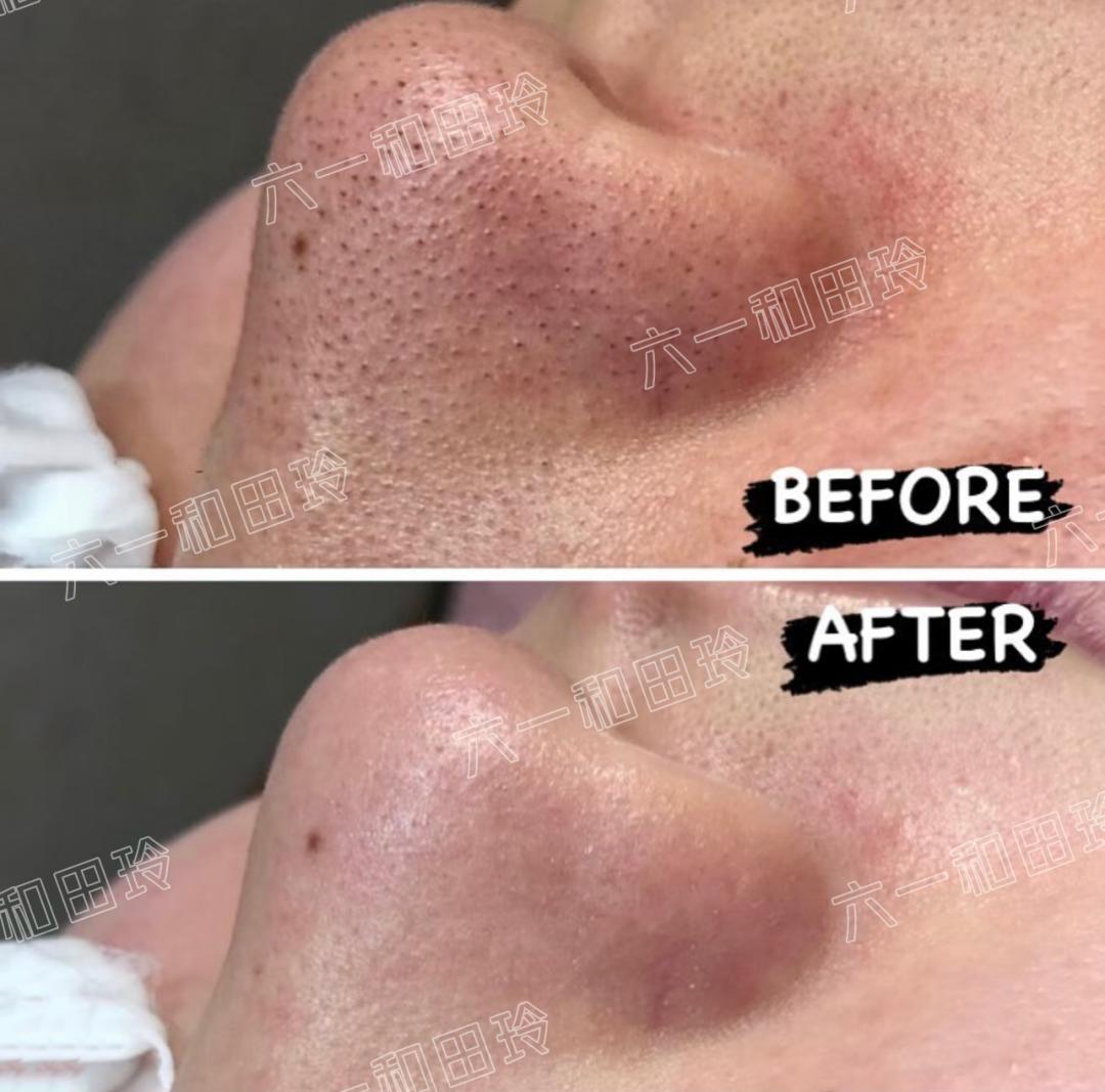 医美刷酸后爆痘期要多久,痘痘肌医美刷酸能好吗