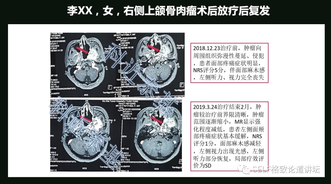 这个装置成功辅助我国两弹爆炸，现在它能治疗肿瘤