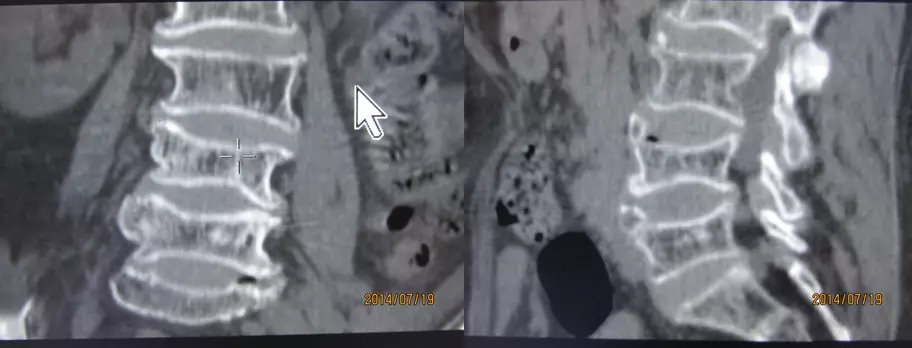 颈椎腰椎疾病ct及mri诊断,腰椎ct可以发现肠部病变吗