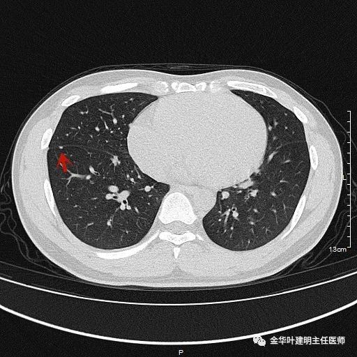 叶建明谈实性结节,叶建明肺实性良性结节会变癌症吗