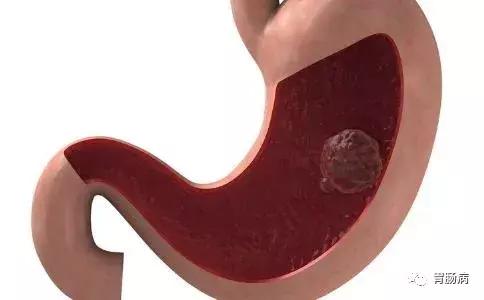 胃息肉，到底要不要斩草除根？