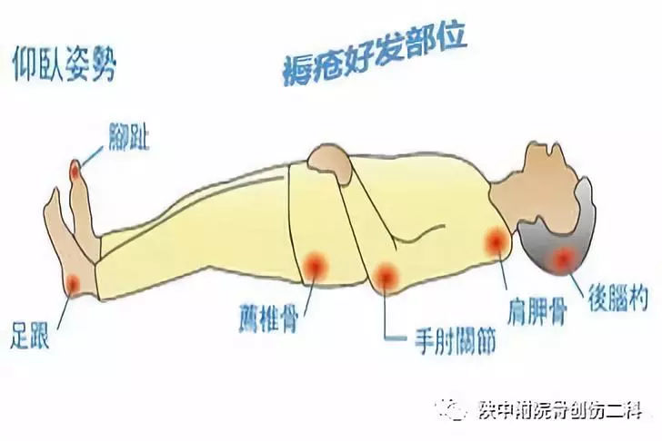 褥疮治疗?你还在每天繁琐的换药吗?