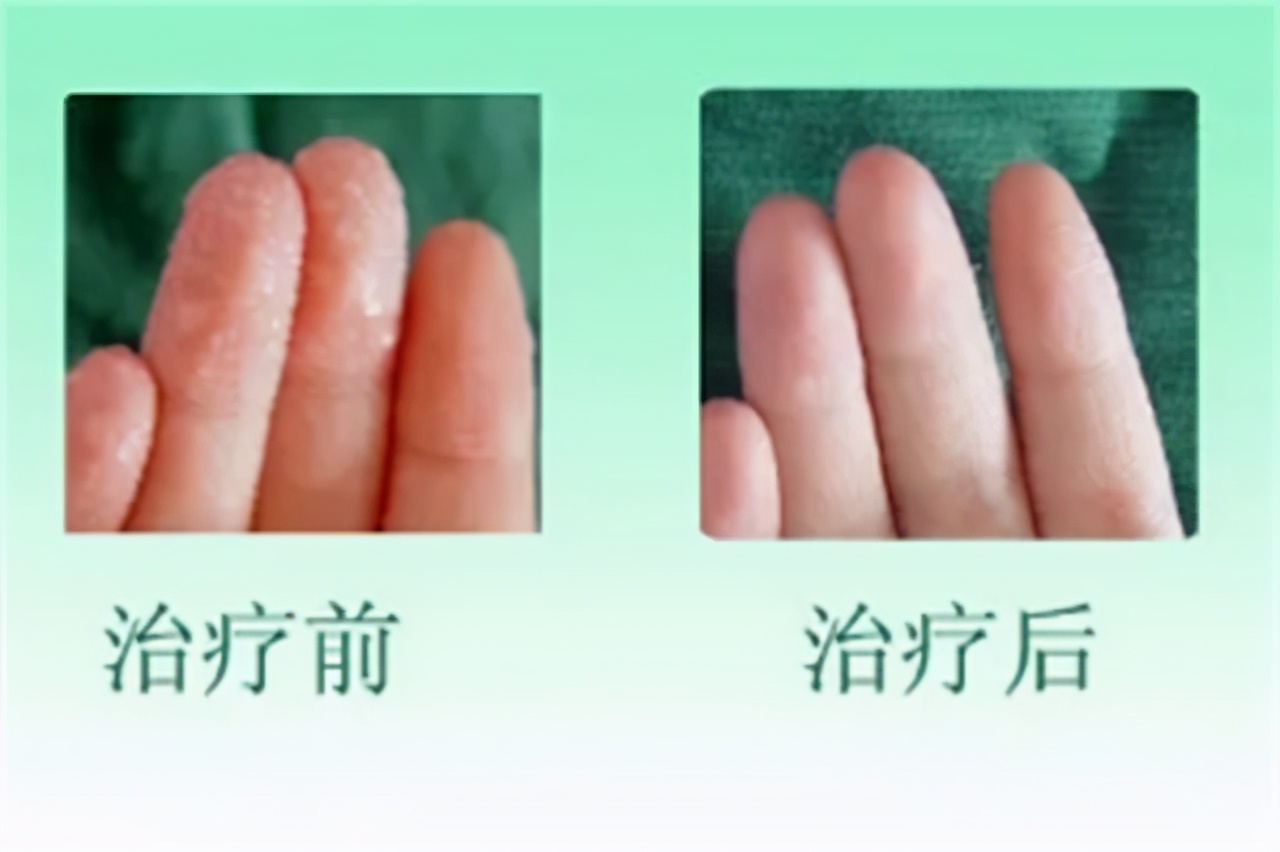 汗手症怎么治疗最有效,治疗手汗症保守的方法