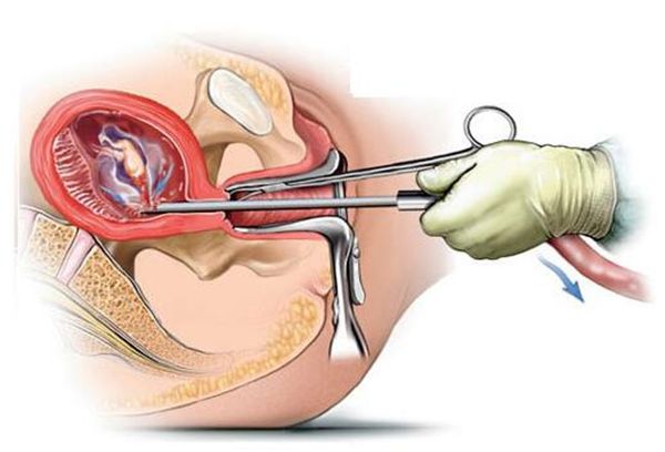 子宫附近罕见肿瘤,子宫一年长了3厘米怎么回事
