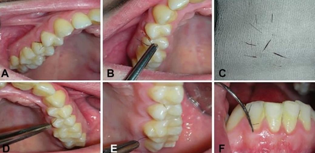 意大利女子牙龈长出睫毛状毛发，历经8年未治愈，病因很常见