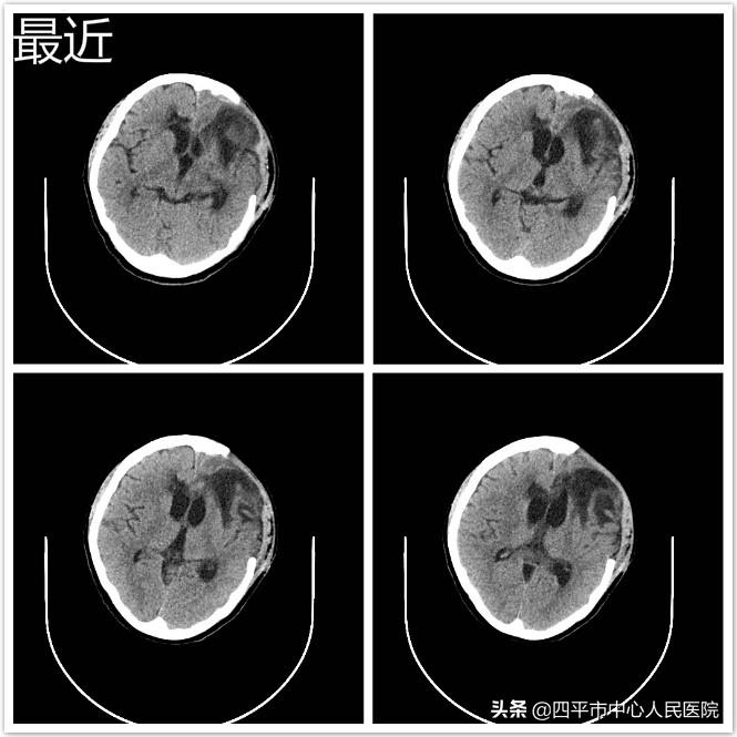 再创生命奇迹——神经外科成功救治白血病继发脑出血病危患者